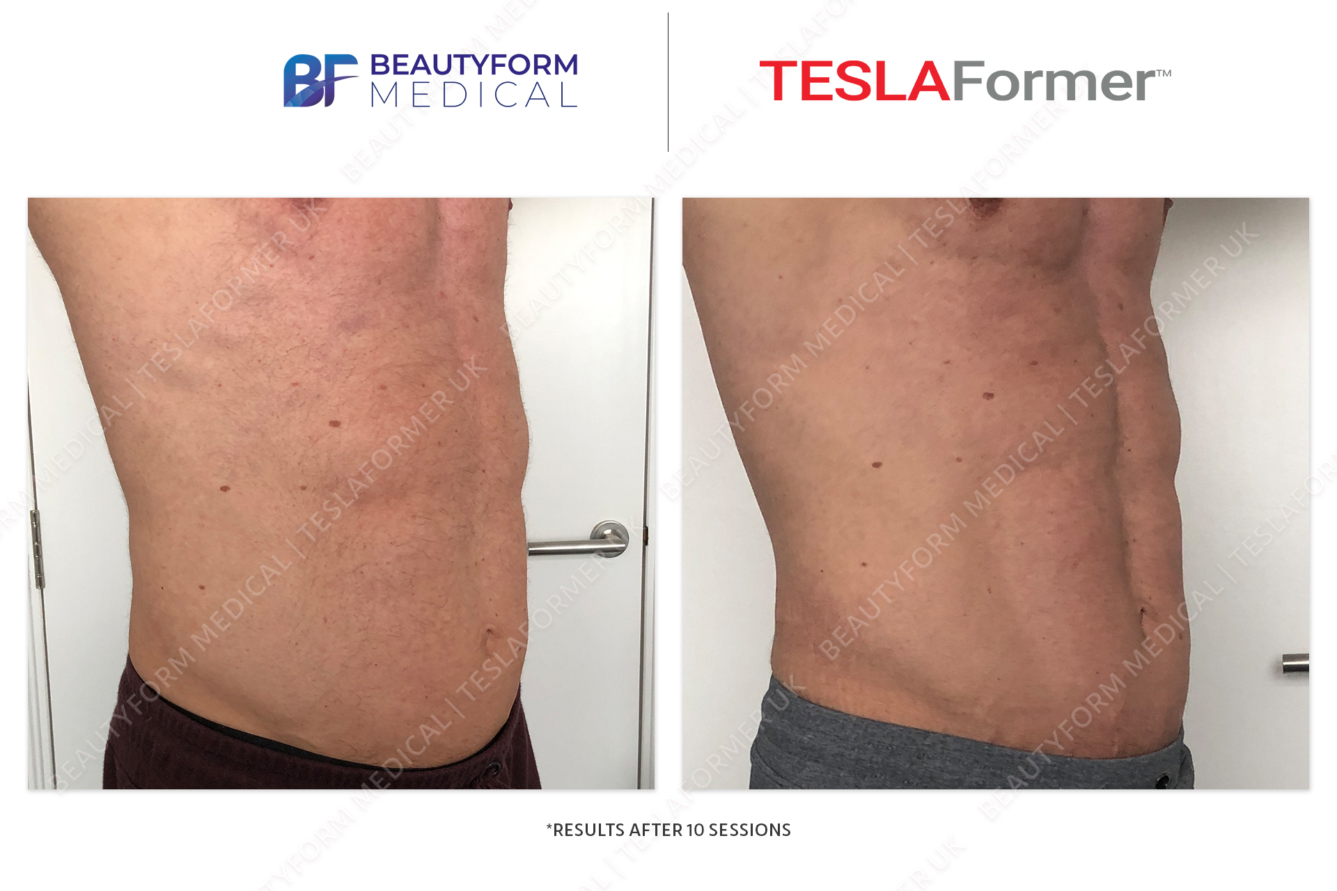 TESLA Former Before after photos