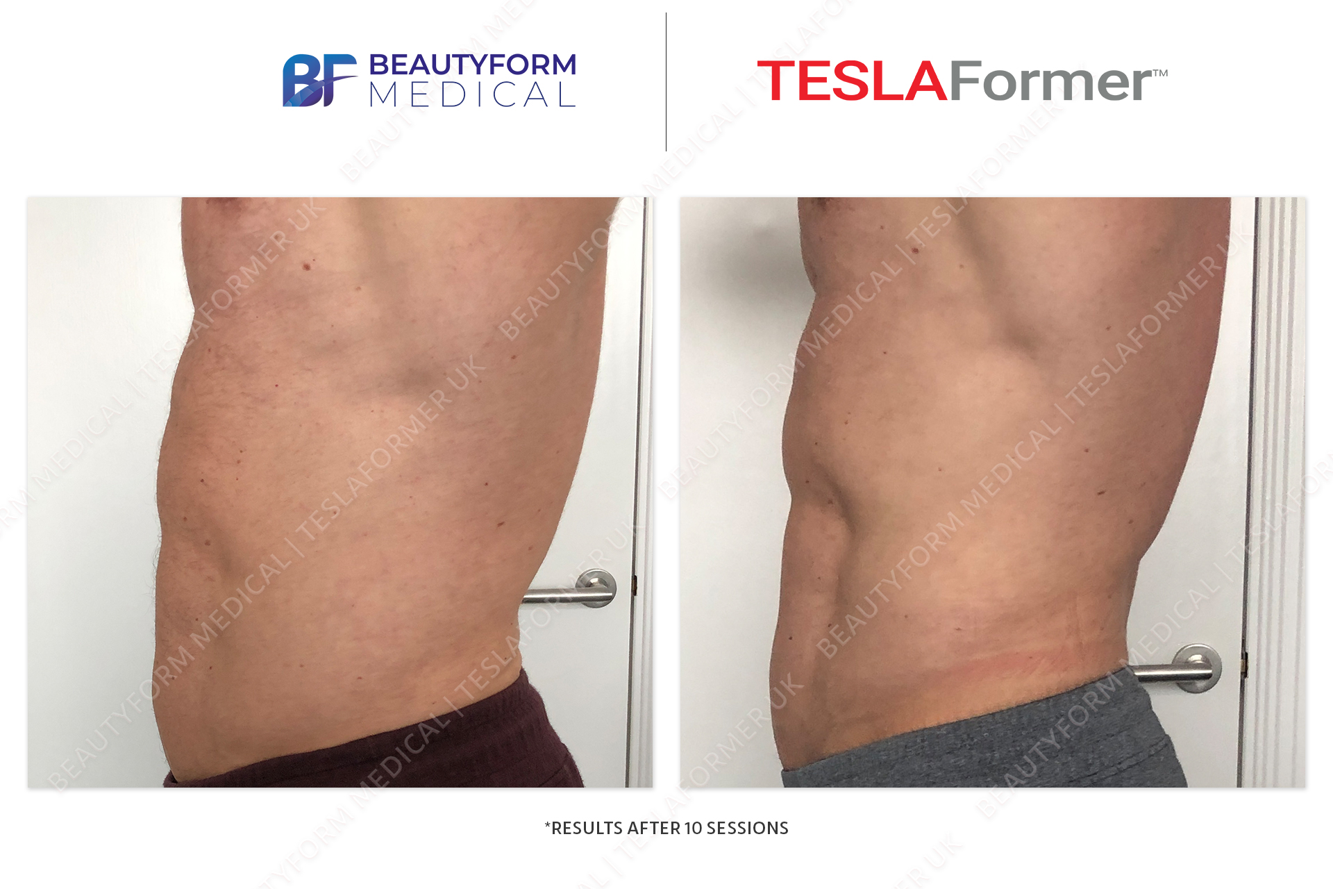 TESLA Former Before after photos