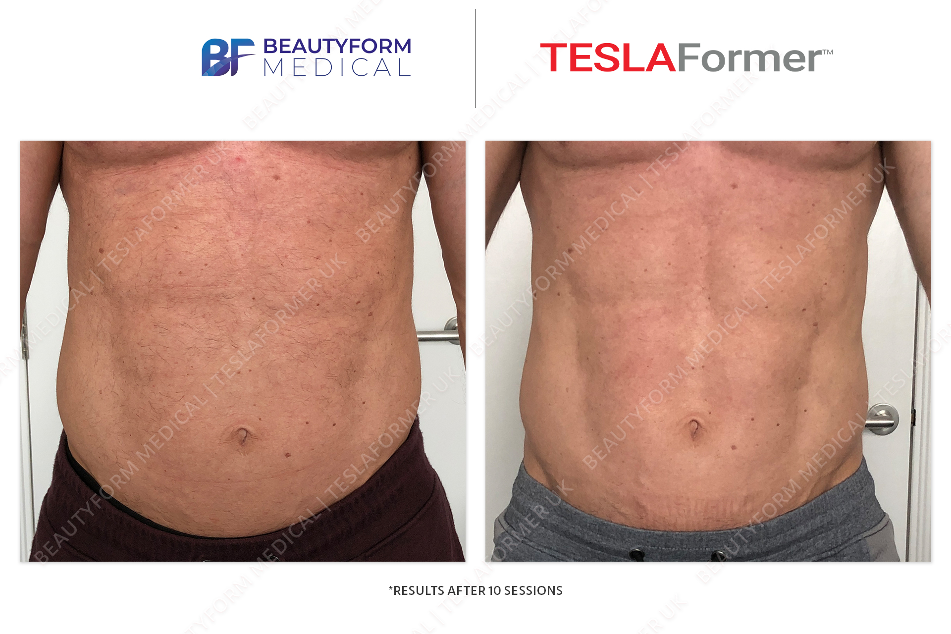 TESLA Former Before after photos