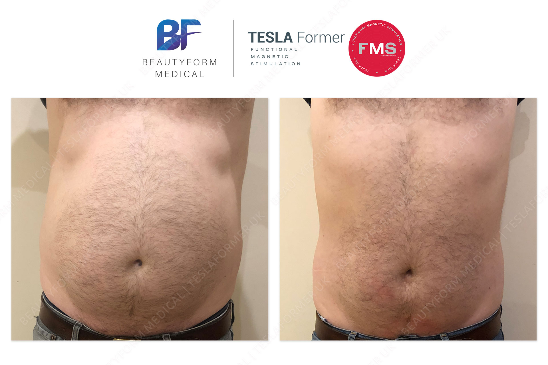 TESLA Former Before after photos